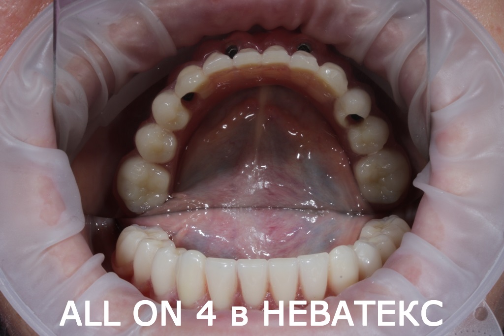 Так выглядят зубы за 1 день по технологии All on 4 зубы за 1 день